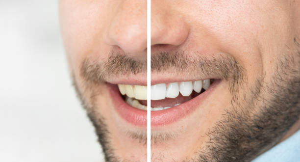 Teeth Whitening Treatment